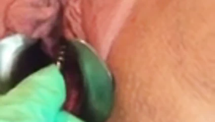 Üretral sondaj nervürlü ses