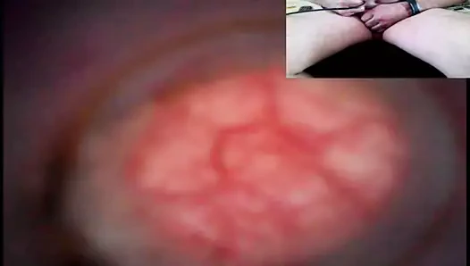 Üretrayı iki kamerayla aşağı indirin