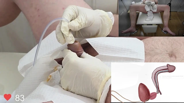 Anatomili foley kateter sokma