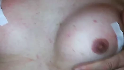 Salin enjeksiyonundan sonra büyük göğüsler