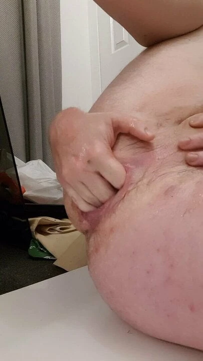 Anal fisting &amp; prolapsus
