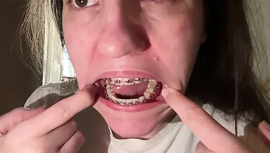 Dilinizle diş teli yalamak