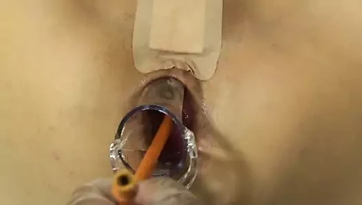 Elmer'in karısı anal fisting spekulum 4