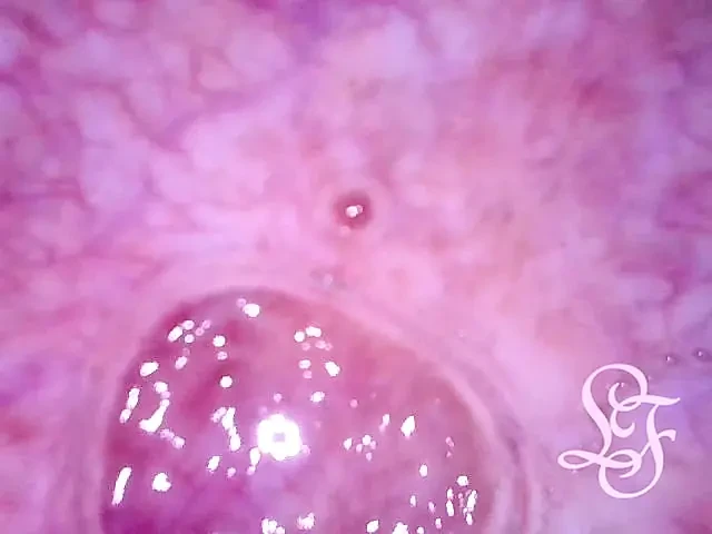 Mini kamera ve bir kateteri aynı anda çiş deliğime sığdırabilir miyim?