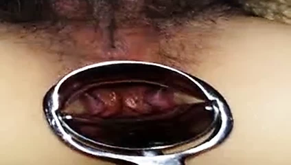 Cusco anüs 1 yerleştirme