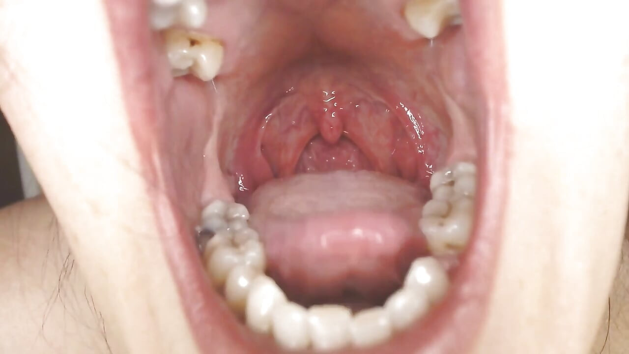 Gırtlağına ve ağzına tükürük ipleri olan Üveula Tonsils