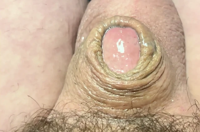 Mikro penis precum aşırı akış