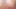 Postop ladyboy kullanımları yapay penis süre Mastürbasyon