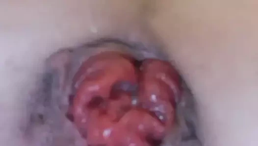 anal itme çıkışları prolapsus