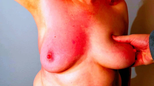 Sağ memesinde 500 vuruş