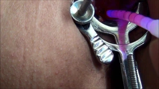 Gelişmiş serviks oyunu