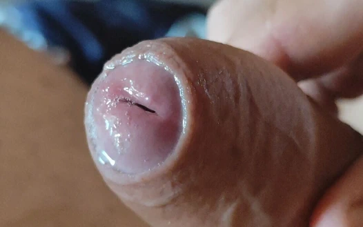 Glans'taki Derin Çatlak Kabarcıklı Sıvı Üretir.