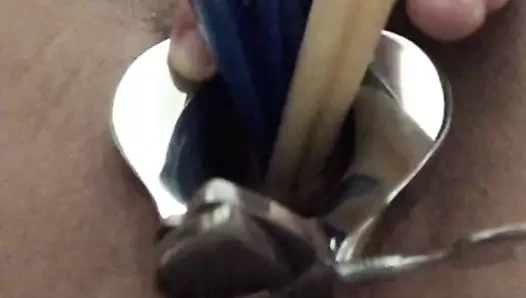 Üretra 7'ye yerleştirildi