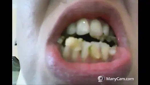 Chantal'ın dişleri çürümüş ve siyah dökülüyor